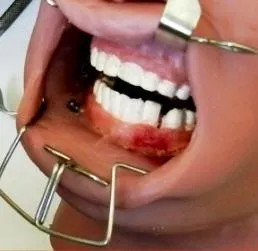 Oral and Maxillo Facial Surgery Simulator with Optional Fractures